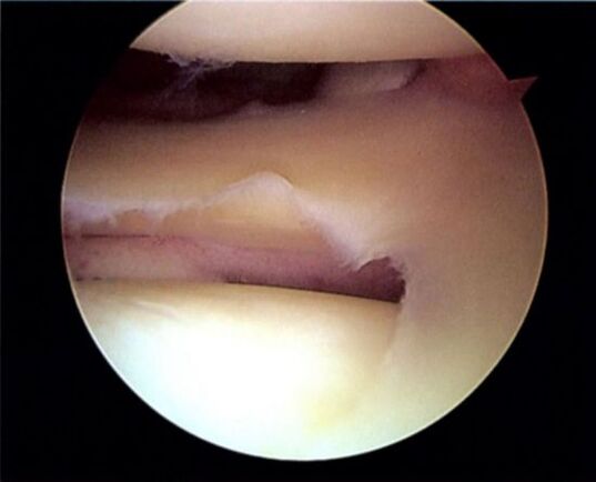 Torn meniscus, leading to osteoarthritis of the knee