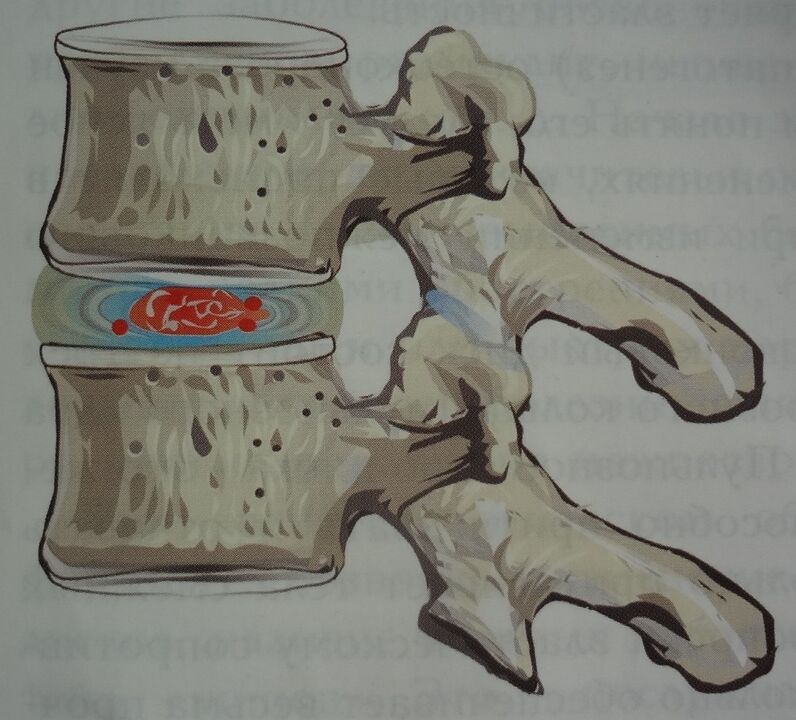 Damage to the pulpal nucleus of the intervertebral disc in the first stage of cervical osteochondrosis
