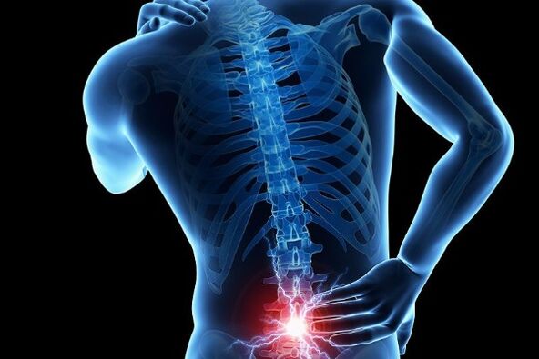 Acute pain in the lower back is a symptom of displacement of the intervertebral discs