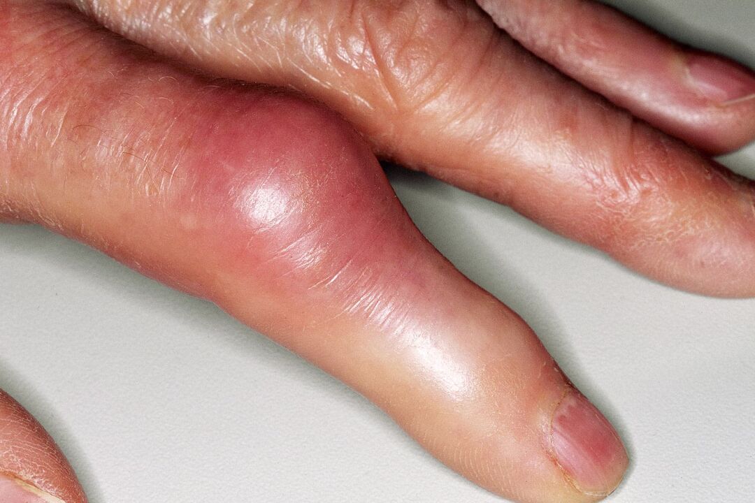 Swelling, deformity of the finger joint and sharp pain after injury
