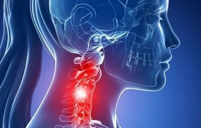 Osteochondrosis of the neck