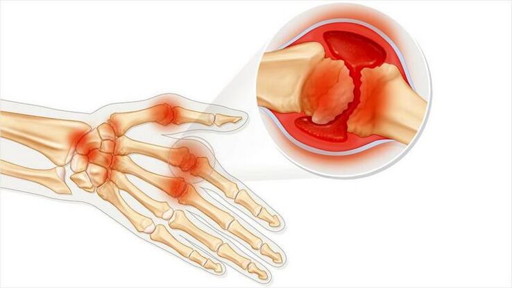 Damage to the joints of the hand due to arthritis