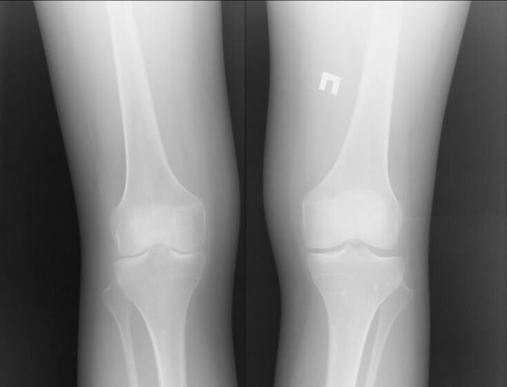 X -ray of the knees affected by arthrosis