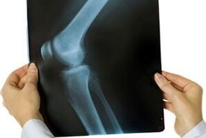 arthrosis of the knee joint on an X-ray