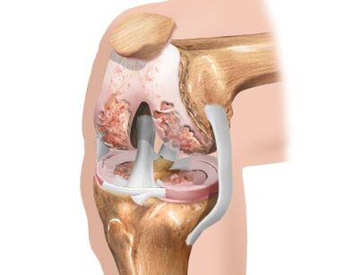 destruction of the knee joint due to arthrosis