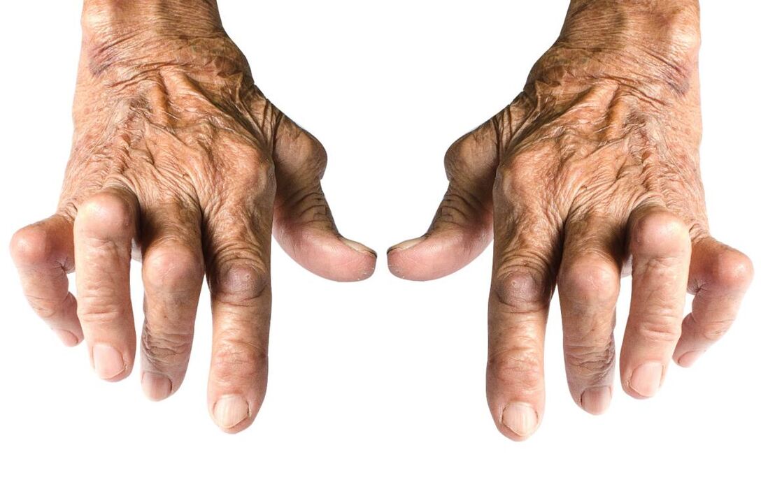 signs of arthritis - deformity of the joints